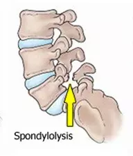 Spondylolysis aka Pars Defect